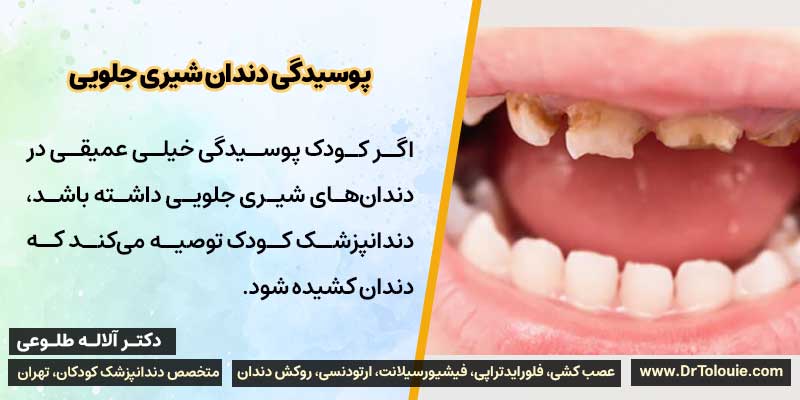 پوسیدگی عمیق در دندان شیری جلویی کودکان