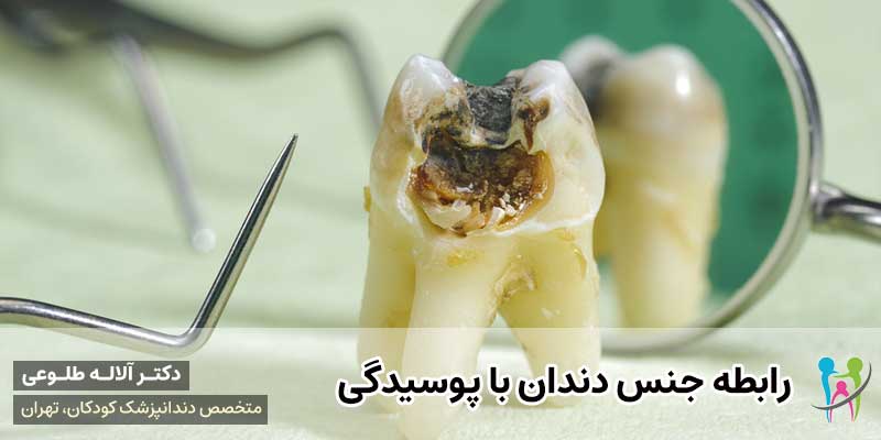 رابطه جنس دندان با پوسیدگی | دکتر آلاله طلوعی دندانپزشک کودکان در تهران