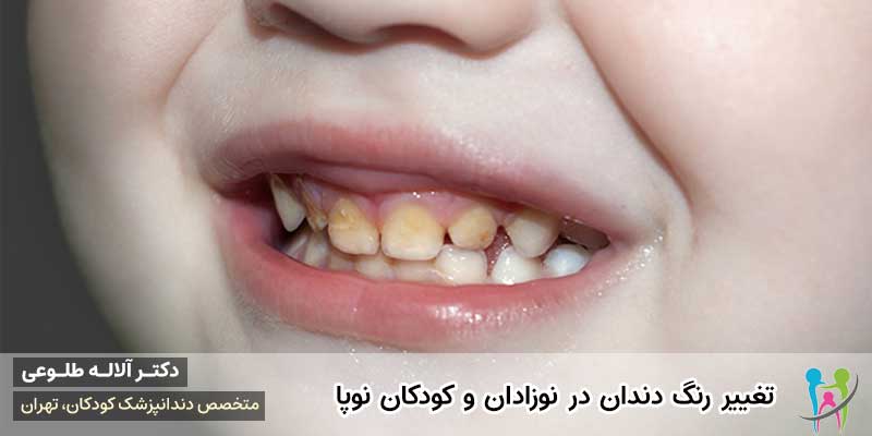 تغییر رنگ دندان در نوزادان و کودکان نوپا | دکتر آلاله طلوعی