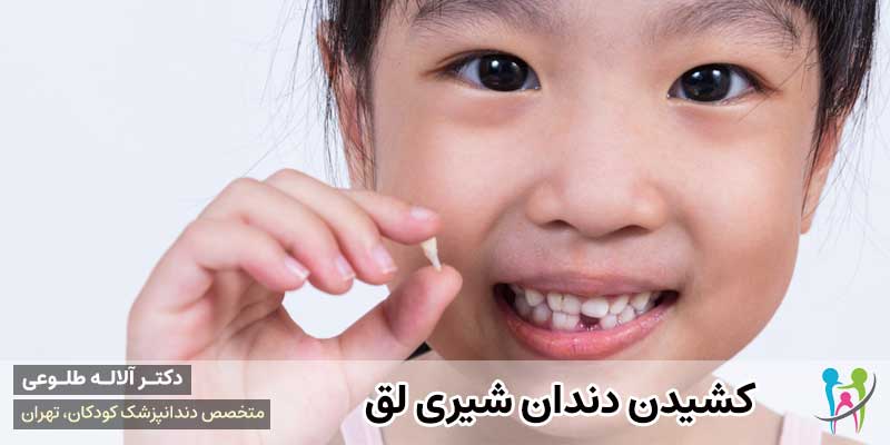 کشیدن دندان شیری لق