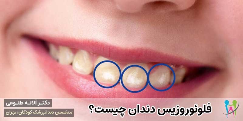 فلوئوروزيس دندان چیست؟