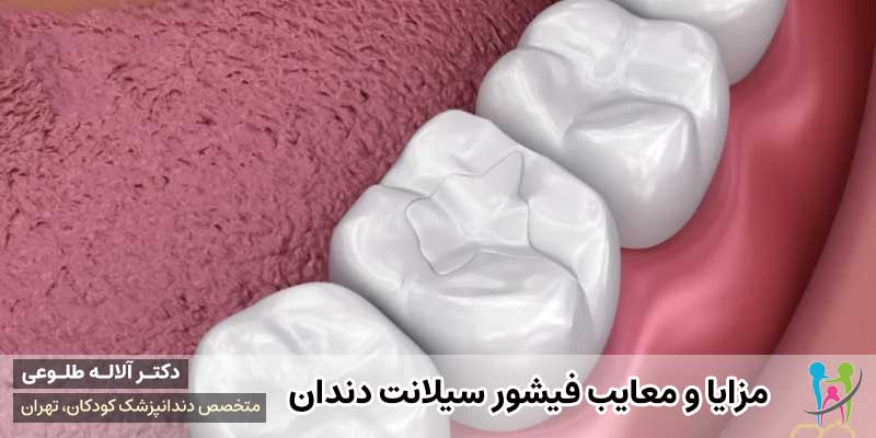 مزایا و معایب فیشور سیلانت دندان کودکان