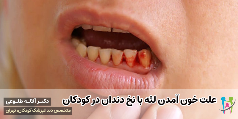 علت خون آمدن لثه با نخ دندان در کودکان